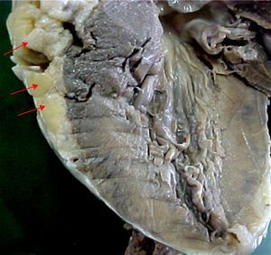 Corazón de un paciente masculino de 52 años de edad, hipertenso, diabético tipo 2; nótese la gran cantidad de grasa epicárdica (flechas rojas) alrededor del ventrículo izquierdo.
