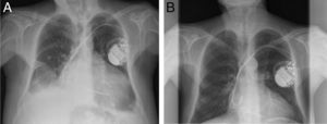 A) Radiografía de tórax en el primer ingreso (Medicina Interna). B) Radiografía de tórax en el segundo ingreso (Nefrología).