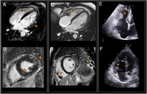 Izquierda: primera RMC. A y B) RTG septo y cara lateral del VI (puntas de flecha). Centro: RMC de control. C) Secuencia de cine que muestra trombo en el VD (punta de flecha). D) RTG epicárdico en cara lateral del VI, trombos en VD e infarto pulmonar (puntas de flecha). Derecha: ecocardiograma. Trombos en interior de VD en el primer (E) y segundo estudios (F). RMC: resonancia magnética cardíaca; RTG: realce tardío de gadolinio; VD: ventrículo derecho; VI: ventrículo izquierdo.
