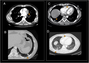 Primer angio-TC. A) Tromboembolismo segmentario oclusivo en arteria del LII (punta de flecha). B) Condensaciones periféricas por infartos pulmonares en el LII (punta de flecha). Segundo angio-TC. C y D) Infarto pulmonar en el lóbulo inferior derecho. Trombo en el ventrículo derecho (puntas de flecha). Angio-TC: angiografía de tórax por tomografía computarizada; LID: lóbulo inferior derecho; LII: lóbulo inferior izquierdo.
