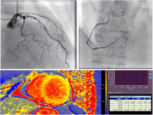 A) Arterias coronarias sin lesiones significativas. B) Resonancia magnética cardiaca con T1 mapping elevado (4,67 Z-scores por encima del valor normal).