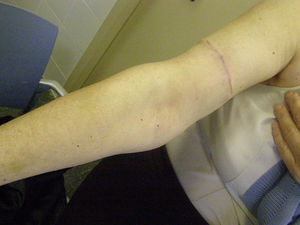 (A y B) Melanoma amelanocítico.