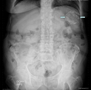 Radiografía del abdomen. Lesión calcificada de 5cm de diámetro en el hipocondrio izquierdo (flechas).