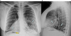 Radiografía posteroanterior y lateral de tórax. Bronquiectasias quísticas bibasales (flechas azules); dextrocardia con situs inversus (burbuja gástrica en el lado derecho con flecha naranja).