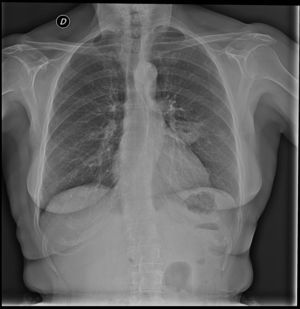 Radiografía de tórax inicial en atención primaria.