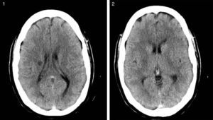 TAC cerebral en la que se aprecia una lesión hipodensa de 7mm de diámetro en la corona radiada derecha, compatible con infarto lacunar.