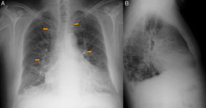 A y B) Radiografía PA y lateral de tórax: ensanchamiento mediastínico e hiliar bilateral (flechas), patrón reticulonodular en ambas bases y deformidad en la pared costal izquierda compatible con fracturas costales antiguas.