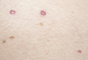 Forma más típica de presentación de los angiomas seniles o puntos rubí: aparecen múltiples lesiones distribuidas por la superficie corporal.