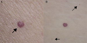 Composición de imágenes que muestra una lesión única tipo punto rubí (A) y su típica apariencia, así como una lesión de angioma senil acompañada de otras lesiones satélite de menor tamaño señaladas con flechas (B).