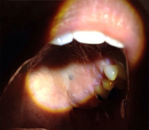 Lesión pigmentaria en el tercio posterior del paladar.