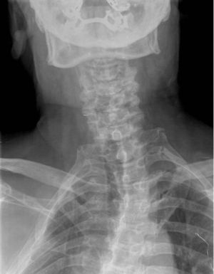 Radiografía anteroposterior de columna cervical con escoliosis de convexidad izquierda.
