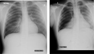Neumotórax derecho: desplazamiento del mediastino a la izquierda.