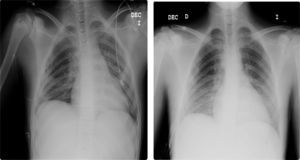 Resolución del neumotórax tras colocación de un tubo de drenaje pleural.