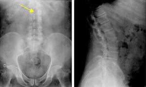 Radiografía de columna lumbosacra AP y L: estrechamiento del espacio L5-S1, deformidad del cuerpo vertebral L3 (flecha amarilla).