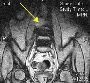 RMN de columna lumbosacra: protrusión discal L5-S1, imagen de masa paravertebral que invade L3 (flecha amarilla).