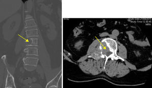 TAC de la columna lumbosacra con reconstrucción 3D: imagen lítica que afecta al hemicuerpo derecho, al pedículo y a la apófosis transversa de la L3, sugestiva de metástasis (flechas amarillas).