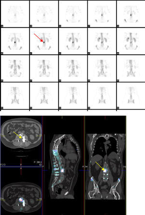 Gammagrafía posquirúrgica: captación del radioisótopo en la vértebra L3 intervenida (flechas).