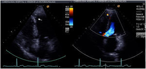 Control ecocardiográfico a los 6 meses de seguimiento. A) Dispositivo bien apuesto en tabique interventricular. B) Mínimo shunt residual.