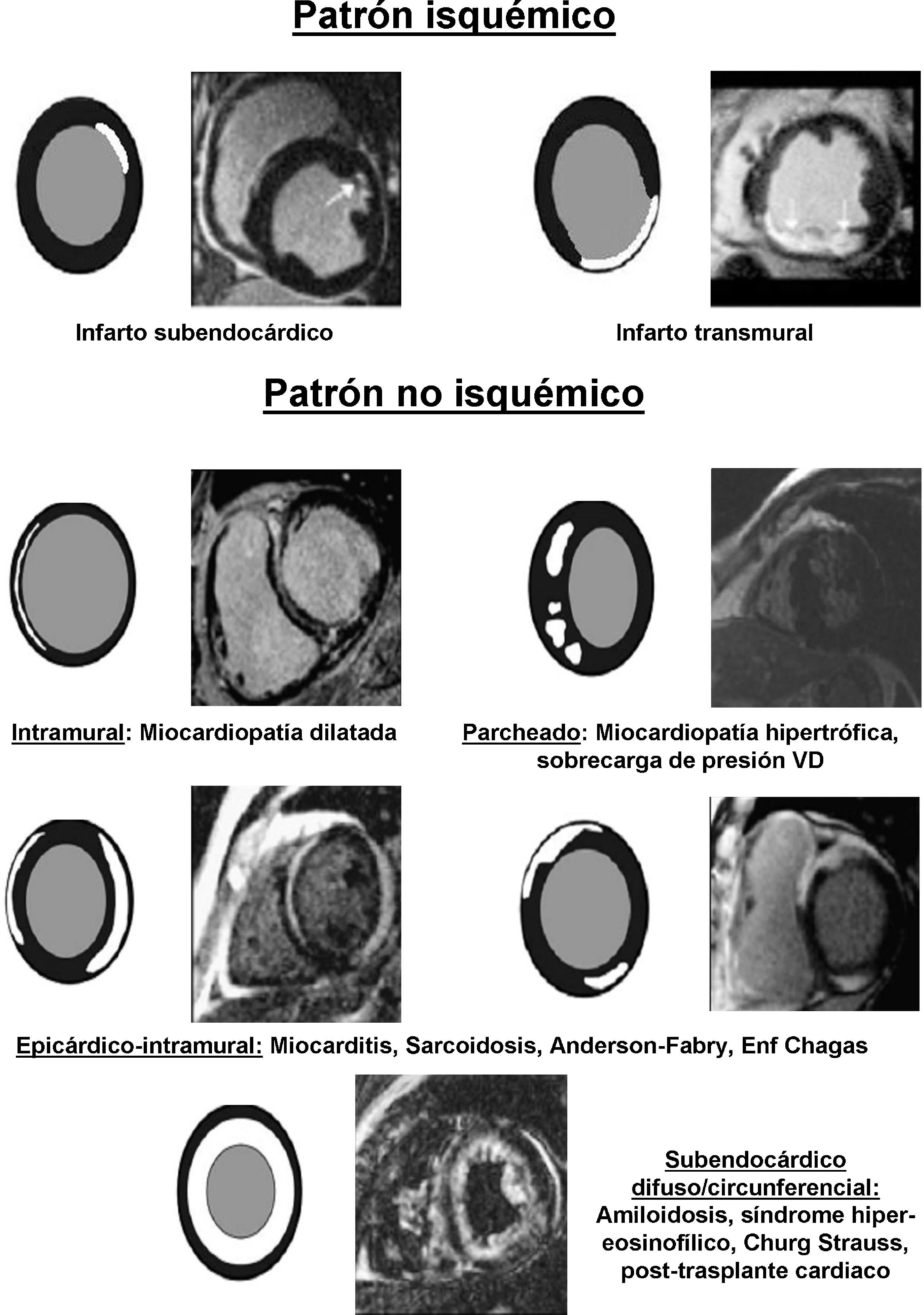 Valor diagnóstico de la resonancia magnética cardiaca en la