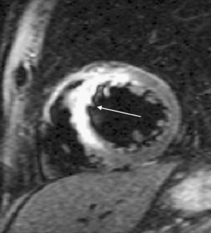 Imagen de secuencias potenciadas en T2 de un paciente con infarto agudo de miocardio (eje corto) que muestra una zonabrillante de señal (edema tisular) en septo anterior (flecha) y representa el área en riesgo.