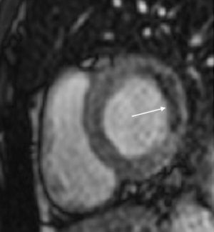 Ejemplo de estudio de perfusión (eje corto) que muestra el primer paso de gadolinio. Bajo infusión de adenosina, el miocardio isquémico muestra una señal significativamente reducida (flecha).