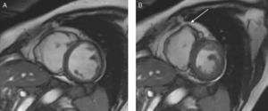 Ejemplo de cardiomiopatía arritmogénica del ventrículo derecho.Secuencias de cine en eje corto. Dilatación ventricular derecha y zona de aneurisma de la pared libre (flecha). A) Final de la diástole. B) Final de la sístole.