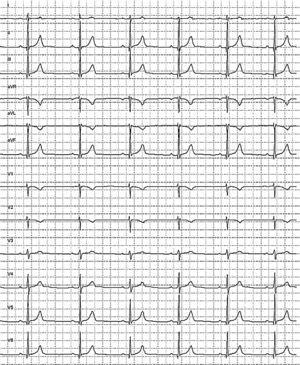 Holter-electrocardiograma realizado a los 10 días del alta que evidencia ritmo sinusal normal con segmento PR normal.