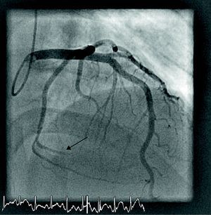La coronariografía urgente realizada al paciente del caso 1 muestra la oclusión trombótica de una rama marginal de la circunfleja de escaso calibre.