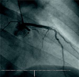 Obstrucción trombótica de la arteria circunfleja proximal en la angioplastia primaria a la que se sometió el paciente del caso 2.