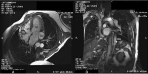 Resonancia magnética. A. Proyección de las cuatro cámaras que muestra el seno coronario (SC) dilatado y la aurícula derecha con apéndice auricular izquierdo (AAI). VI: ventrículo izquierdo; VD: ventrículo derecho. B. Corte sagital en el que se observa la presencia de dos bazos (B). Dilatación del sistema hemiácigos (HA), que canaliza el drenaje venoso infradiafragmático hacia la vena cava superior izquierda.