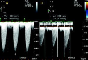 Doppler continuo con medición de gradiente máximo entre ventrículo izquierdo y aorta. A. Preoperatorio: gradiente transvalvular máximo de 94 mmHg. B. Postoperatorio: gradiente transprotésico máximo de 34 mmHg.