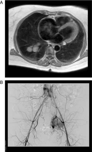 A. Resonancia magnética, corte axial en T1. Se muestra una masa única tumoral de origen pélvico que alcanza a invadir cavidades cardíacas derechas. Las formaciones nodulares en el parénquima pulmonar derecho de localizaciones parahiliares y posteriores son sugestivas de implantes metastásicos. B. Arteriografía de arteria aorta y vasos femorales. Se visualizan formaciones aneurismáticas venosas gigantes localizadas en territorio pélvico izquierdo, en relación a fístulas arteriovenosas que presentan relleno de contraste precozmente.