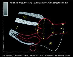 Esquema de ecocardiograma transtorácico (ETT), proyección paraesternal. Se muestran los niveles de medición de la aorta proximal.