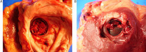 Hallazgo en necropsia. Trombosis mitral masiva. A) Visión desde la cara auricular. B) Visión desde la cara ventricular.