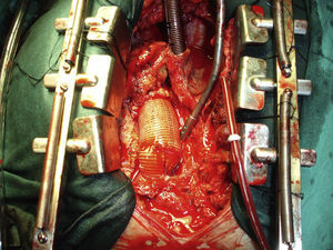 Sustitución de aorta ascendente y hemiarco por injerto protésico de Dacron, como consecuencia de un aneurisma a este nivel.