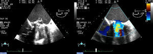 Las imágenes de ecocardiografía transesofágica muestran la presencia de un trombo grande sobre prótesis mitral metálica que provoca obstrucción y restricción del flujo de uno de los hemidiscos.