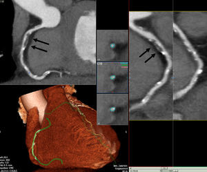 Arteria coronaria derecha difusamente enferma con una placa fibrolipídica con remodelado positivo (flechas negras) en el segmento proximal.
