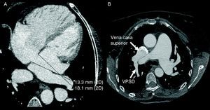 Comunicación interauricular visualizada por tomografía computarizada en visión de 4 cámaras (A) y drenaje venoso anómalo de la vena pulmonar superior derecha en la vena cava superior (B) en un mismo paciente. VPSD: vena pulmonar superior derecha.