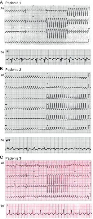 A-C) En cada panel se muestra: a) el electrocardiograma de 12 derivaciones de presentación clínica de cada uno de los pacientes; b) detalle de una derivación electrocardiográfica de cara inferior en la que se observa conducción auriculoventricular variable (pacientes 1 y 2) o 2:1 (paciente 3).