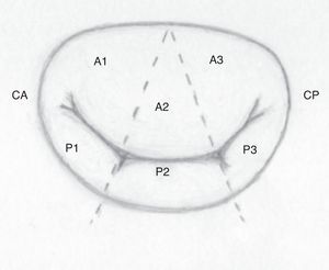 División en segmentos de la válvula mitral. CA: comisura anterior; CP: comisura posterior.