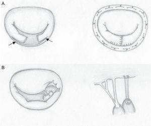 Técnicas quirúrgicas. A) Reparación de velo posterior. En la imagen de la derecha se ha realizado resección cuadrangular y deslizamiento de velo posterior (indicado por la flecha). En la imagen de la izquierda se ha completado la reparación con una anuloplastia. B) Reparación de velo anterior. En la imagen de la derecha se aprecia rotura de cuerdas tendinosas del velo anterior. En la imagen de la izquierda se observa la válvula reparada tras la colocación de la neocuerda.