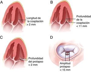 Criterios anatómicos que debe cumplir la válvula mitral para implantación de MitraClip®. A) Longitud de la coaptación>2mm. B) Profundidad de la coaptación<11mm. C) Profundidad del prolapso<2mm. D) Amplitud del prolapso<15mm.