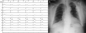 a) El ECG muestra bloqueo auriculoventricular completo y escape ventricular a 35lpm. b) Radiografía de tórax con neuroestimulador a nivel dorsal y marcapasos a nivel pectoral izquierdo, cables auricular y ventricular.