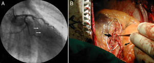 A) Coronariografía en oblicua anterior derecha. Estenosis del segmento medio de la arteria descendente anterior (flechas) en sístole. B) Arteria descendente anterior expuesta y liberada (flecha grande) y puente de arteria mamaria izquierda distal (flecha pequeña).