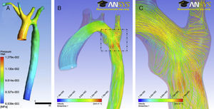 Simulación mediante mecánica de fluidos computacional en un paciente con coartación de la aorta residual. La geometría de la aorta y el flujo específico a través de la válvula aórtica han sido adquiridos mediante resonancia magnética cardiaca. A)Mapa de presión en superficie de la aorta durante el momento sistólico de mayor gradiente a través de la coartación. B)La simulación de las líneas de flujo (streamlines) durante la sístole muestra las áreas con mayor velocidad y wall-shear stress en la región ístmica. C)Ampliación del área rectangular mostrada en B; nótese el patrón de turbulencia en la zona de la coartación residual.