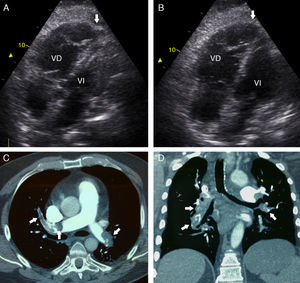 A) Ecocardiografía. La imagen de 4 cámaras en sístole muestra acinesia de la pared libre del VD con hipercinesia del ápex (flecha). B) Ecocardiografía. Imagen de 4 cámaras en diástole, dilatación del VD, ápex de VD (flecha). C) Angiotomografía de tórax con contraste, plano axial. Trombos intraluminales en ambas ramas pulmonares con recanalización parcial (flechas). D) Angiotomografía de tórax con contraste, plano coronal. Trombos intraluminales en ambas ramas pulmonares (flechas). VD: ventrículo derecho; VI: ventrículo izquierdo.