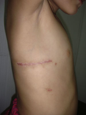 Aspecto de la cicatriz axilar 2 meses después de la intervención.