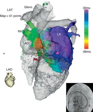 Mapa de activación de una taquicardia por reentrada intranodal integrado en imagen de resonancia magnética nuclear en un paciente con atresia tricuspídea.