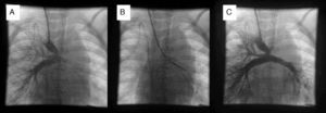 A. Cavografía superior en proyección posteroanterior. A través de la anastomosis cavopulmonar se rellena de contraste la rama derecha y apenas llega contraste a la izquierda. Destaca la disposición distal de un stent previo en la rama izquierda. B. Stent ya colocado y expandido. C. Cavografía superior en proyección posteroanterior. Se observa la mejoría de la perfusión del pulmón izquierdo.