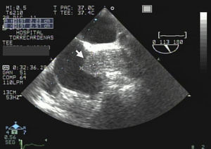 Ecocardiograma transesofágico. Masa de 2,57×2,23cm en la aurícula recercha, implantada en la desembocadura de la vena cava superior (flecha).